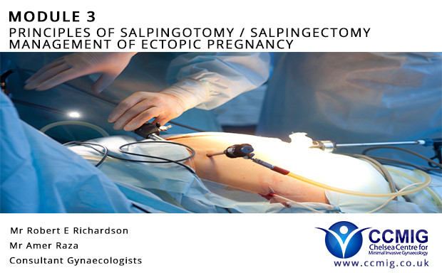 Module 3 Principles Of Salpingotomy Salpingectomy Management Of Ectopic Pregnancy 